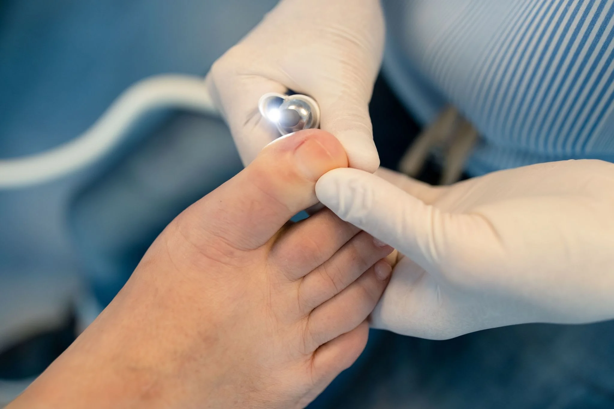 Early signs of fungal nail infection