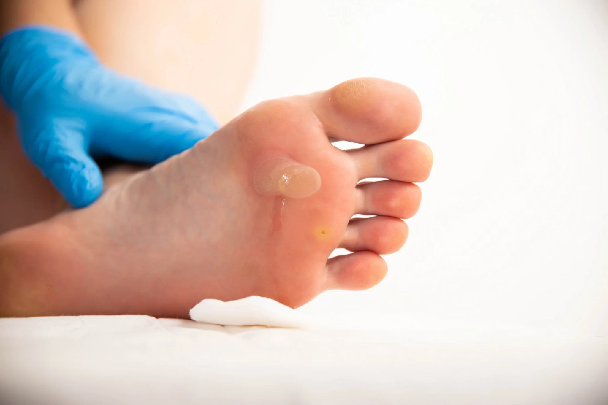Plantar wart removal Sydney