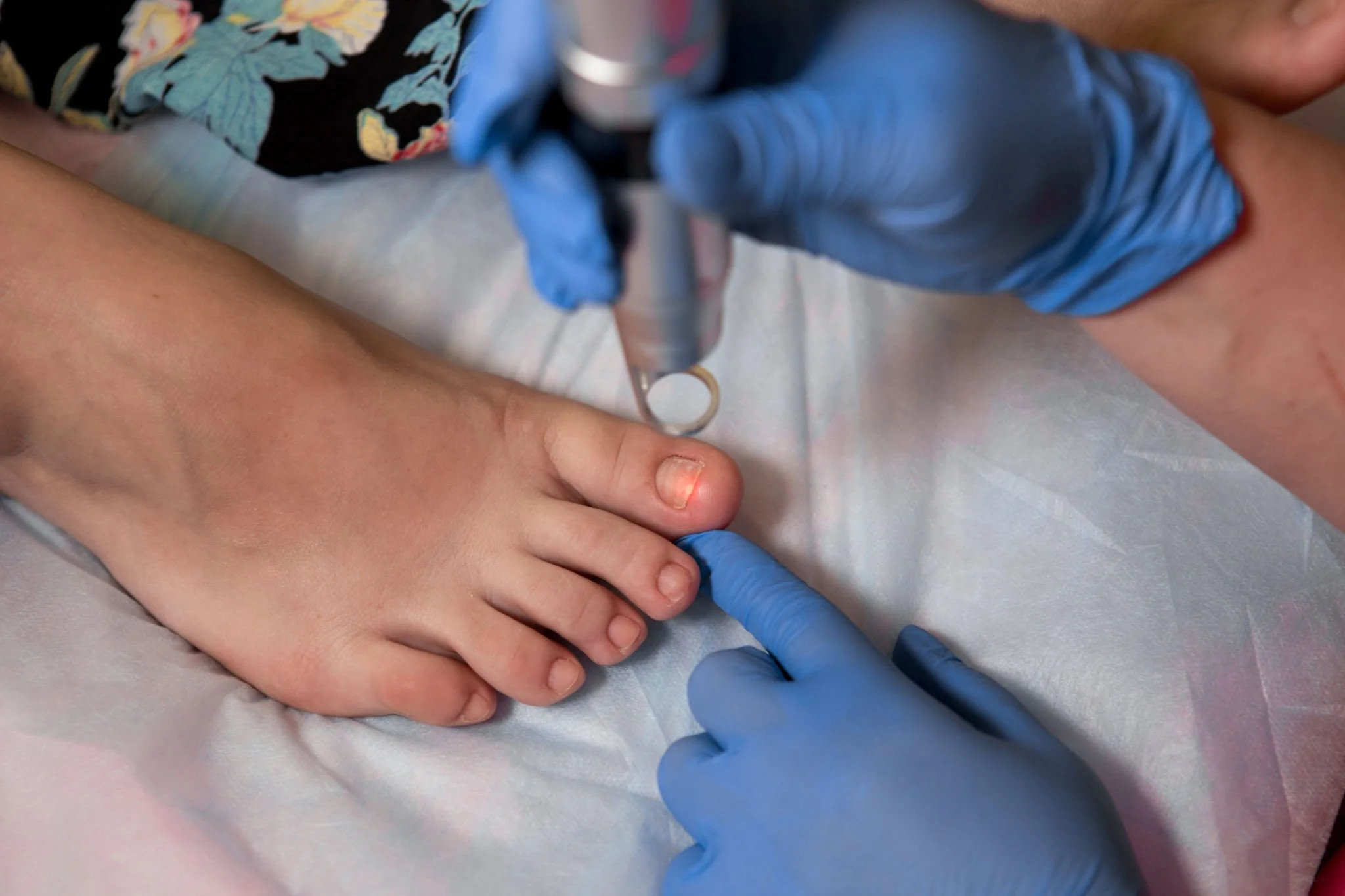 Toenail fungus laser treatment
