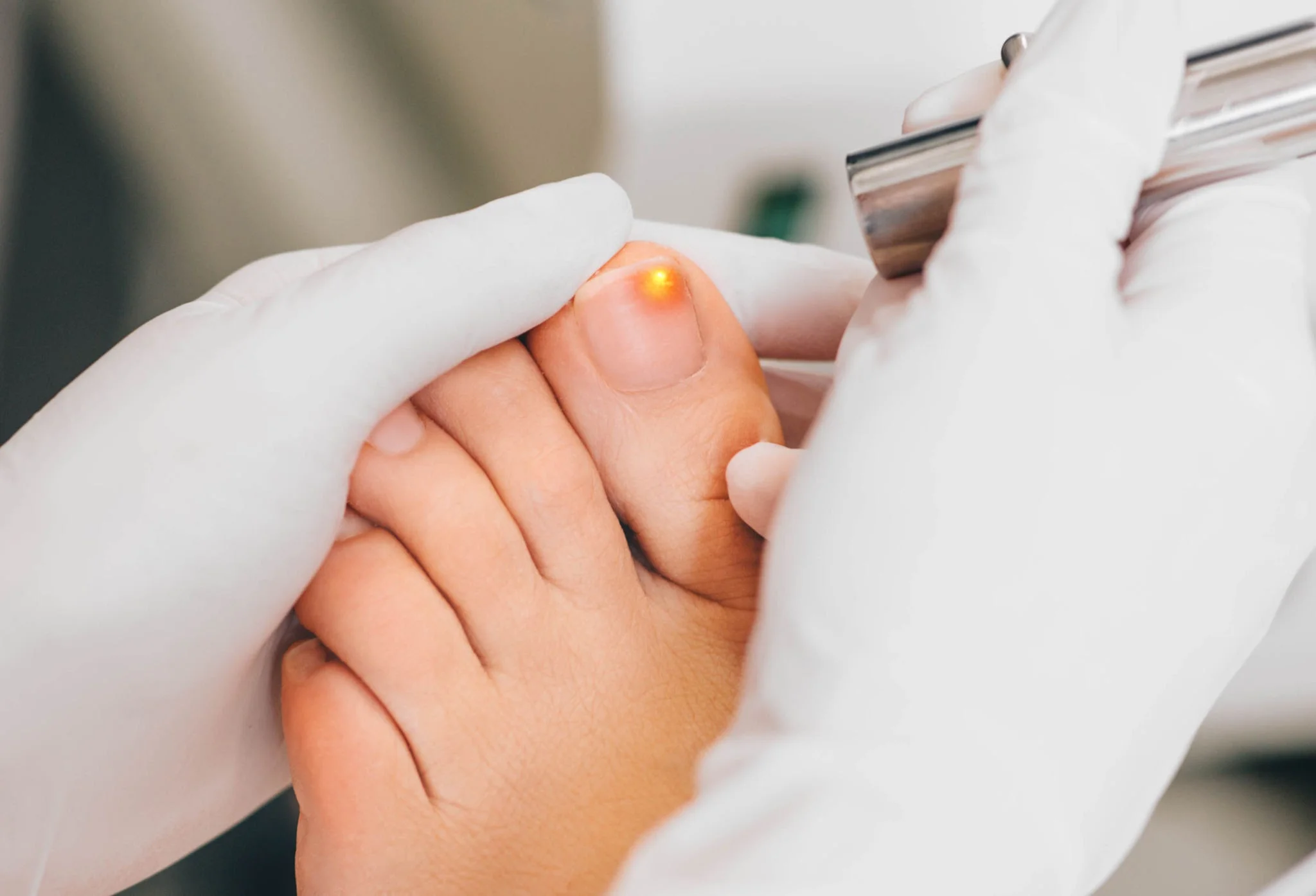 Toenail fungus laser treatment sydney
