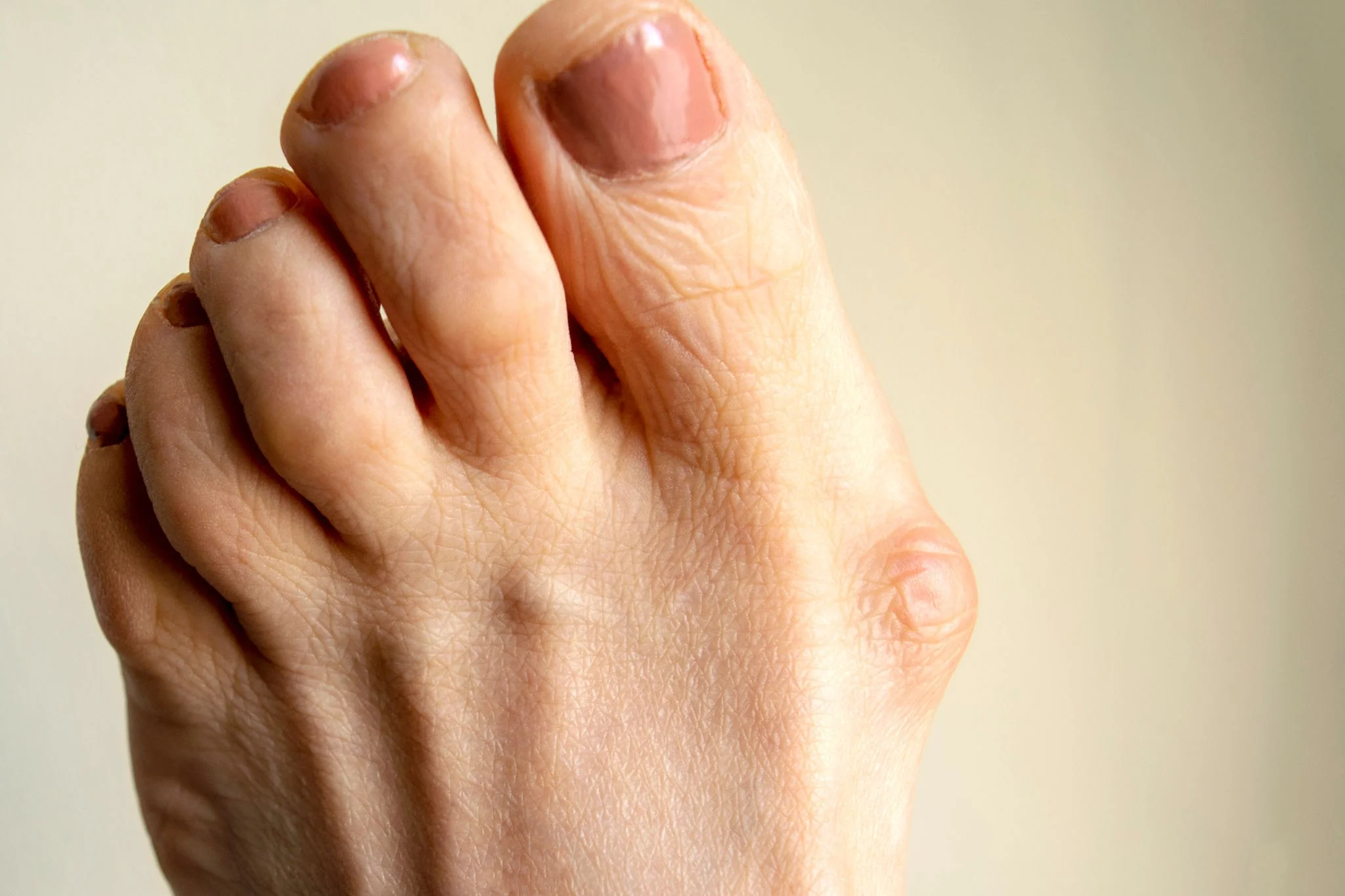 factors of bunions