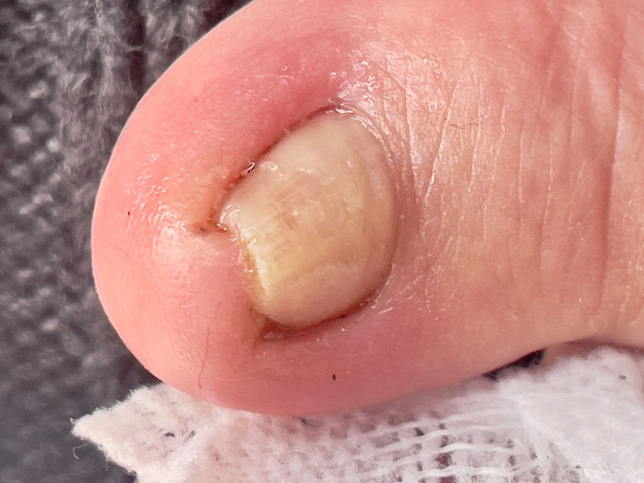 ingrown toenail swelling factors