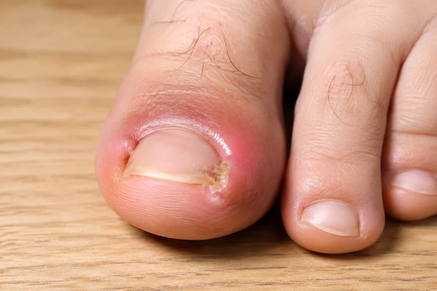 ingrown toenail swelling